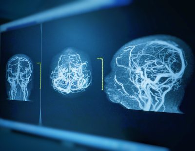 TDAH e o Autismo O Cérebro em Números: O que as Alterações na Espessura Cortical nos Contam 3 1737935700 253