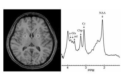 Desvendando os Subtipos do TDAH: Como um Exame Cerebral Revela Diferenças Cruciais 3 Captura de tela 2025 01 28 182213