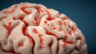 brain infected with eastern equine encephalitis